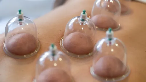 Chinese cupping
